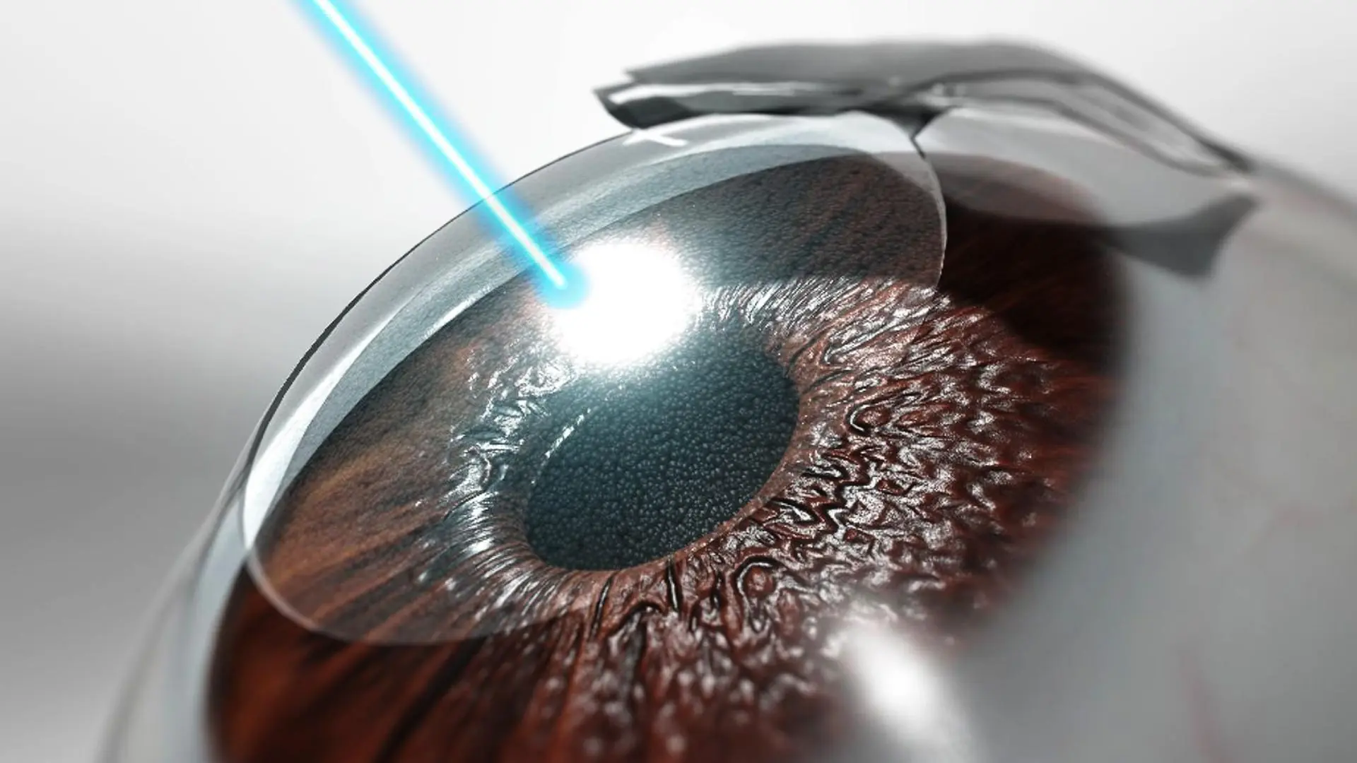 Lasik Lasik Eye Surgery