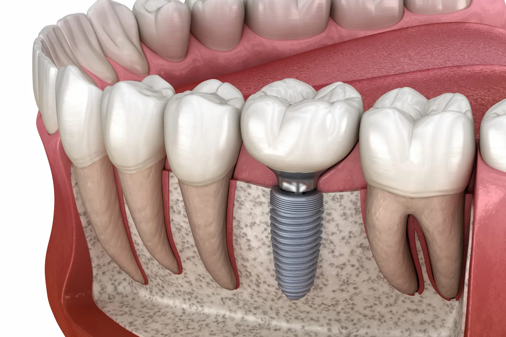 Restorative & Replacement Dental Solutions in Iran