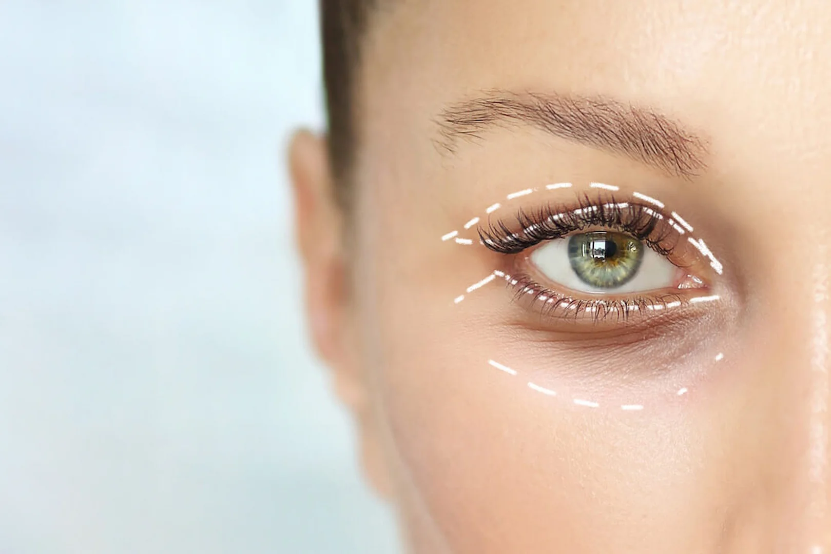 Eyelid & Eye Shape Surgery in Iran