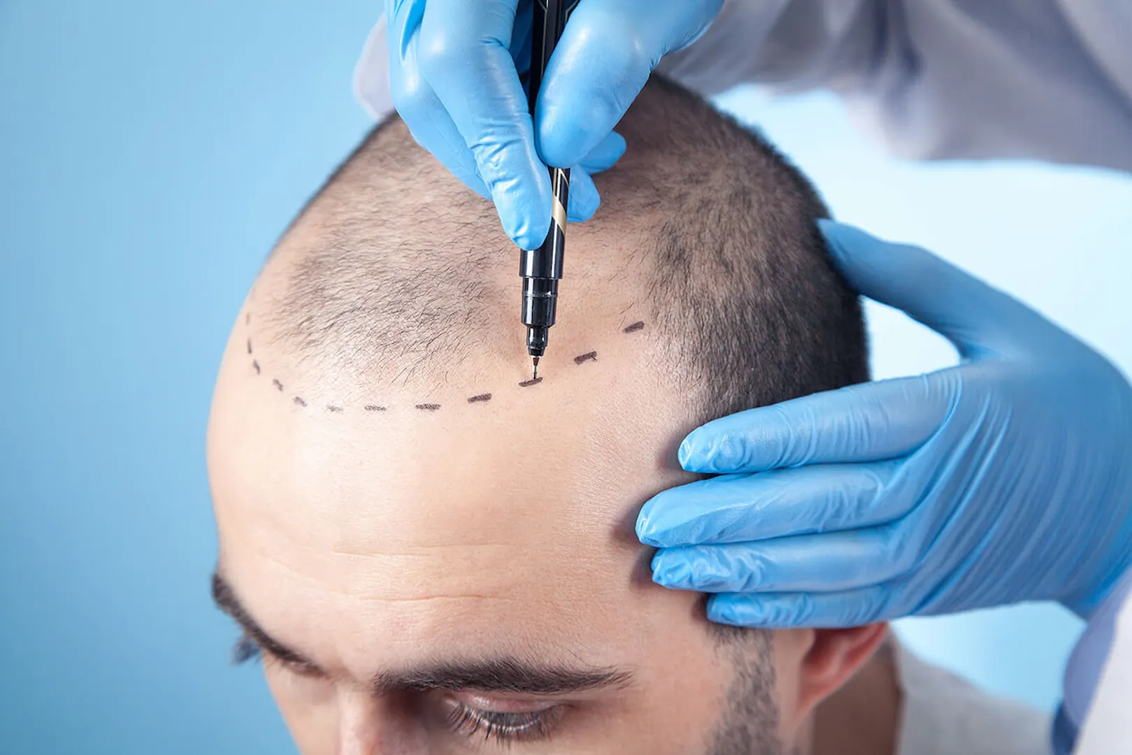 Scalp Hair Transplant in Iran