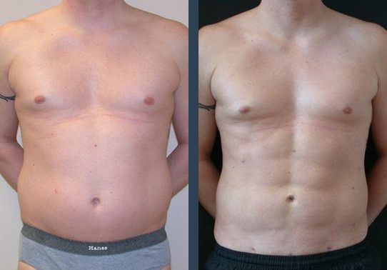 Abdominal Etching Result 1