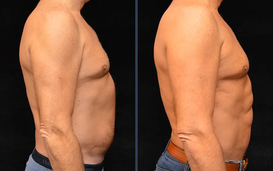 Abdominal Etching Result 3