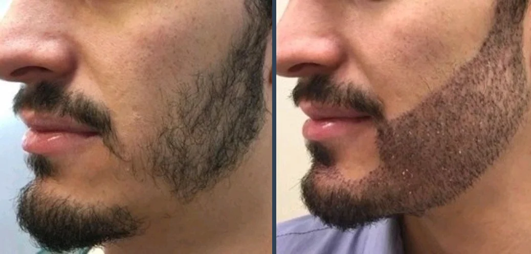 Beard Transplant Result 1