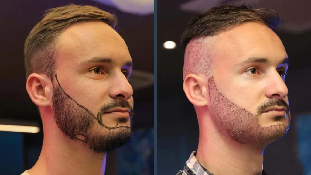 Beard Transplant Result 2
