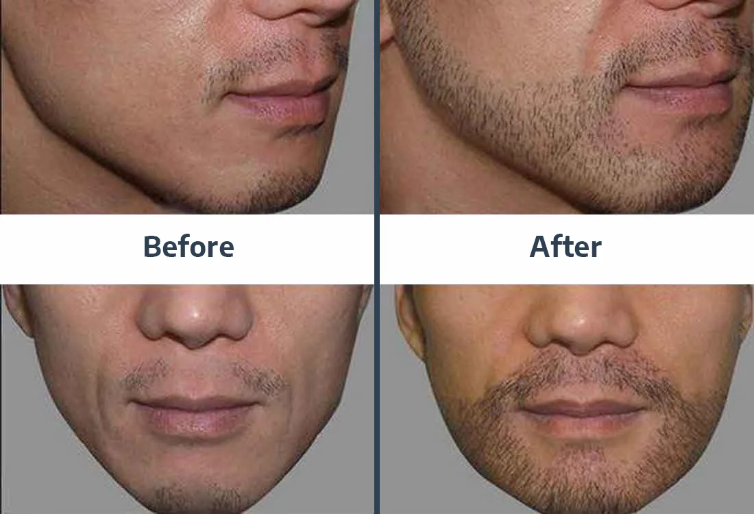Beard Transplant Result 3