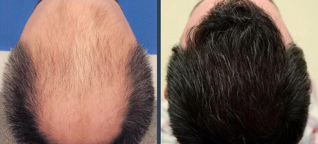 Hair Transplant Result 1