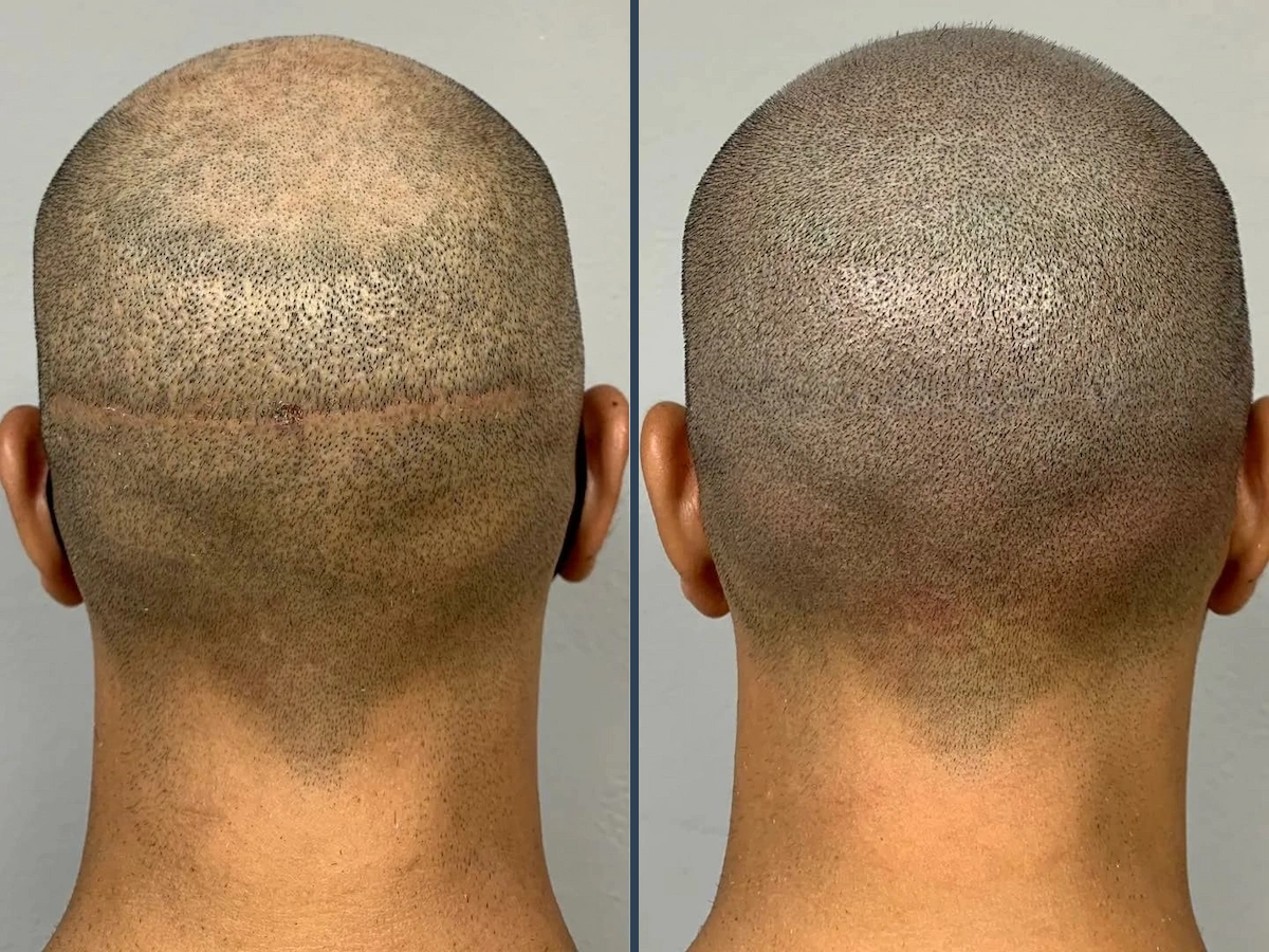 Hair Transplant Result 2
