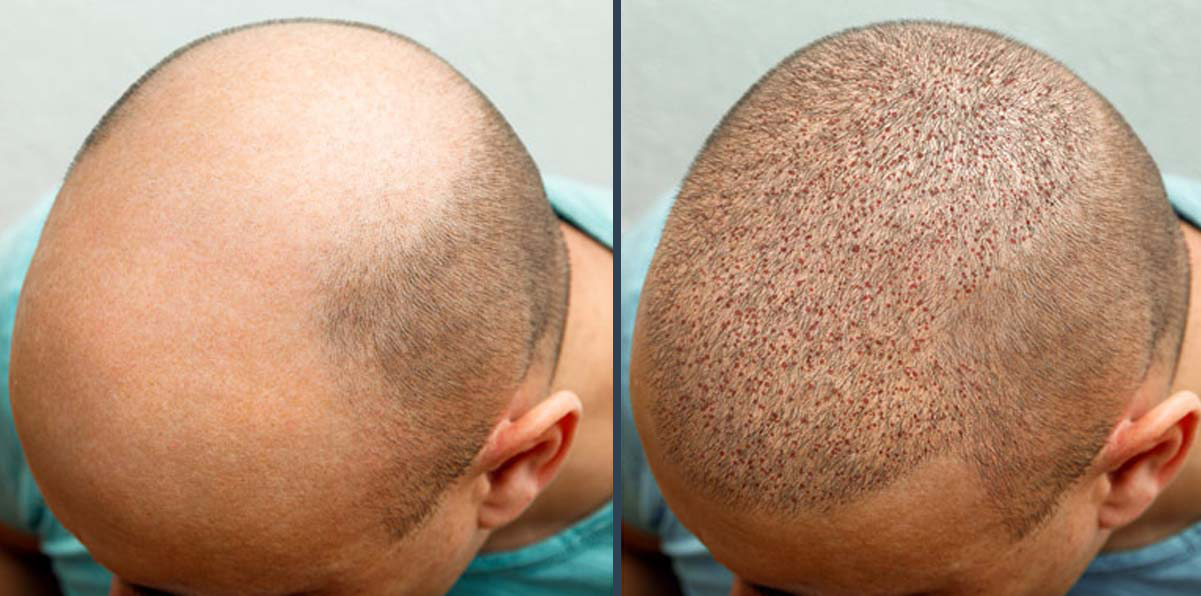 Hair Transplant Result 3