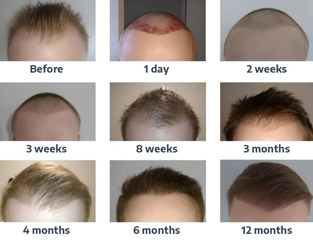 Hair Transplant Result 4
