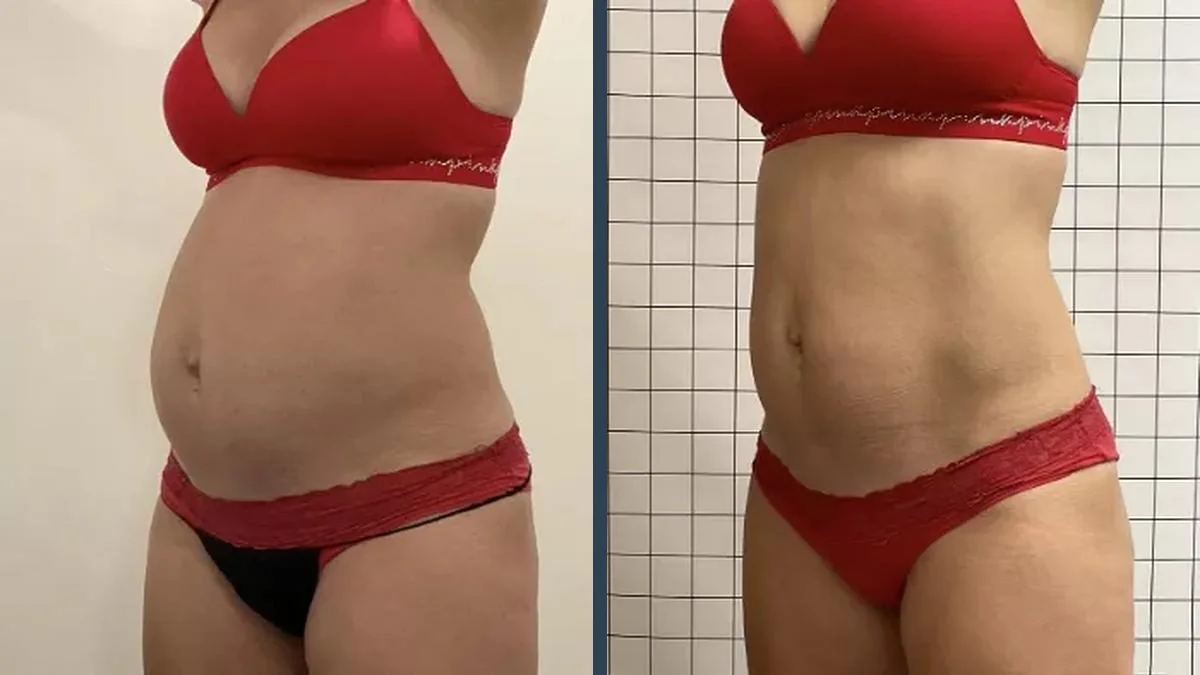 Liposuction Result