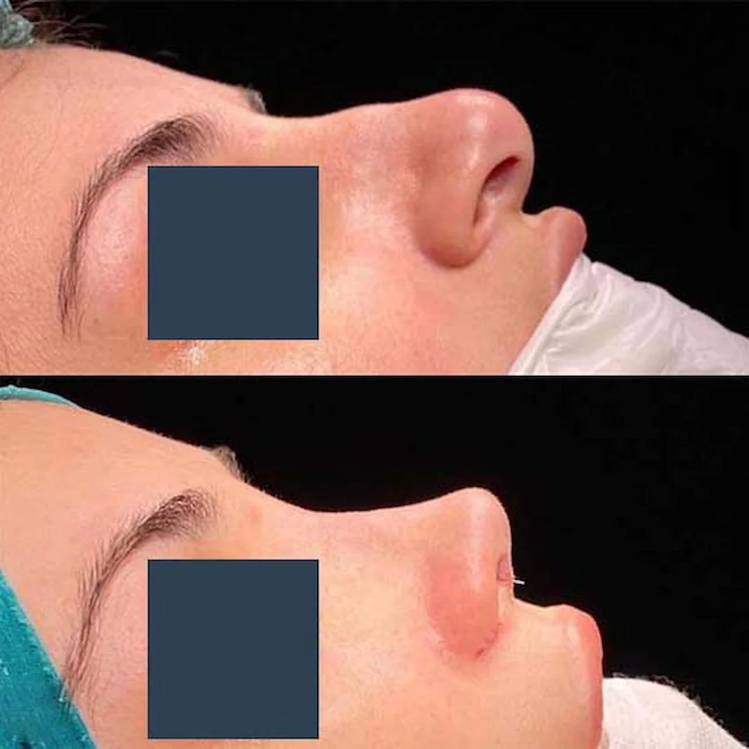 Nose job results 2