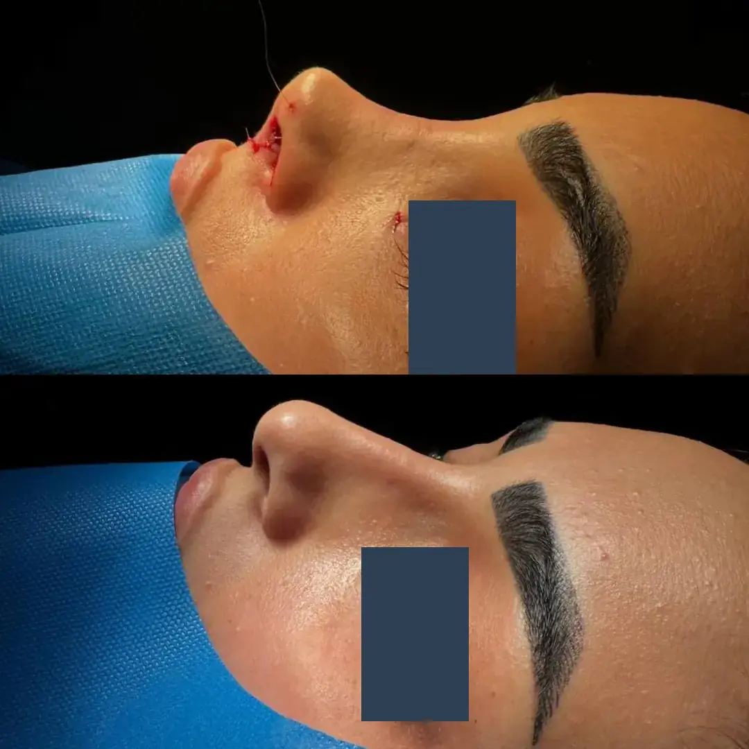 Nose job results 3