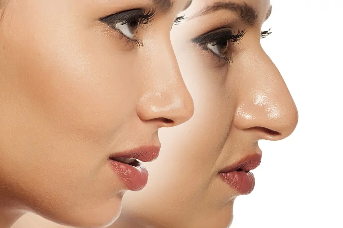 Nose job in Iran before and after