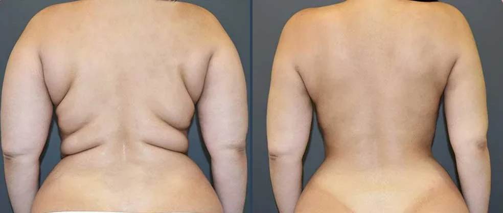 liposuction result 2