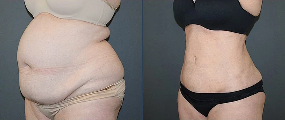 liposuction result 3