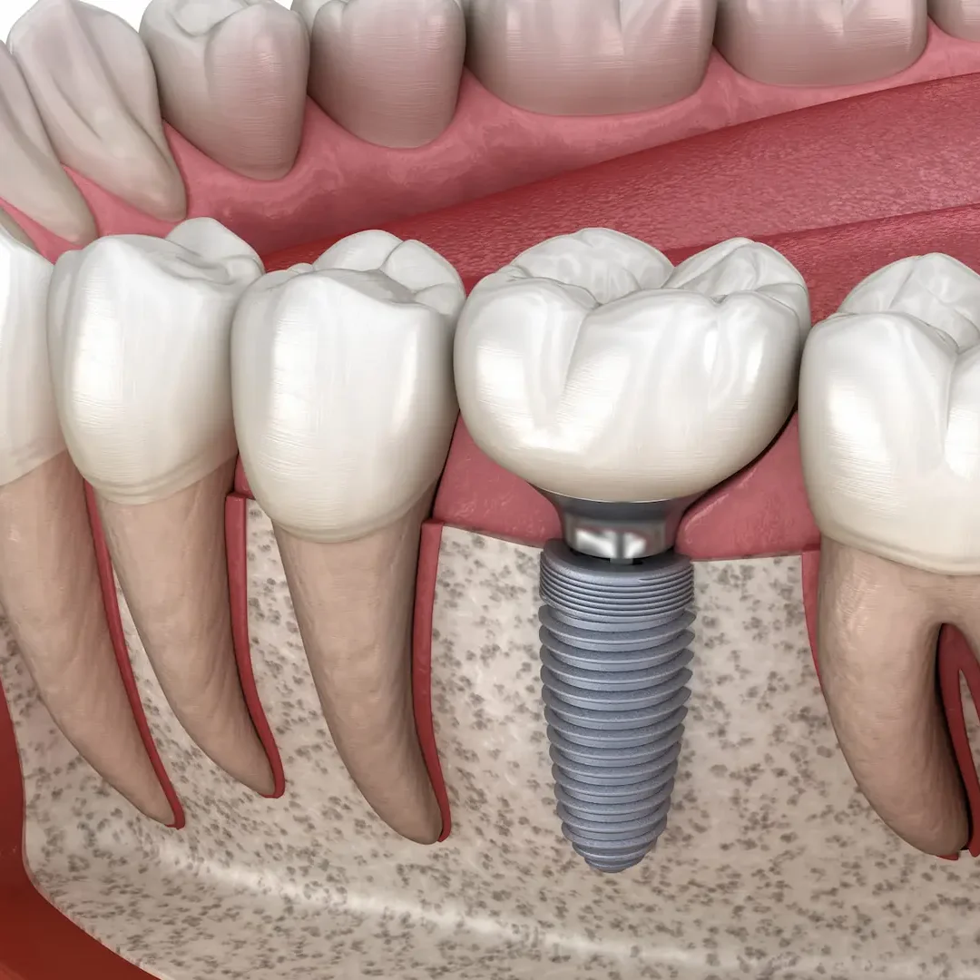 Dental Implant