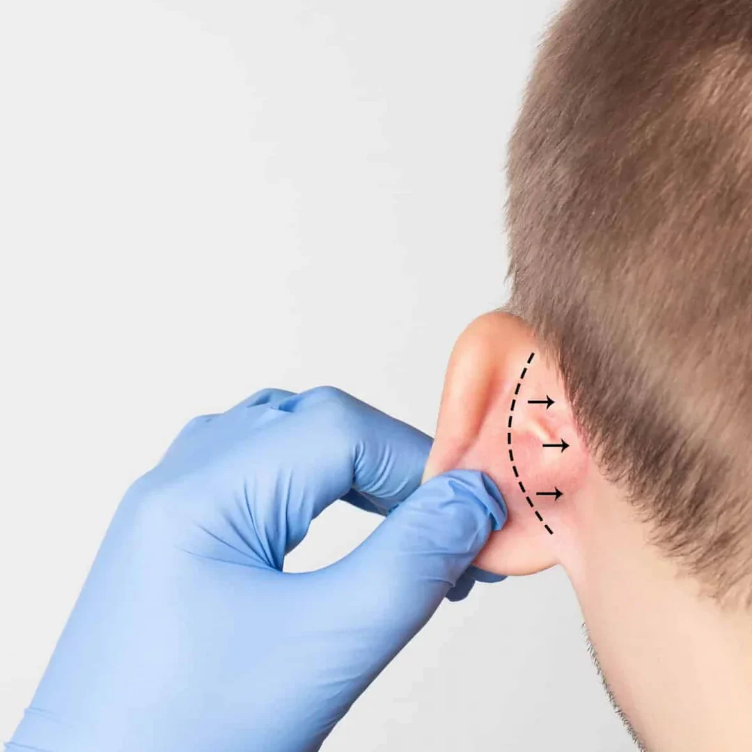 Otoplasty