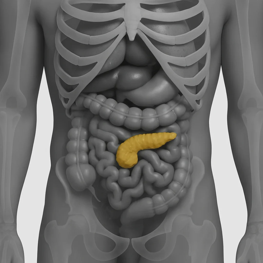 Pancreas Transplant in Iran