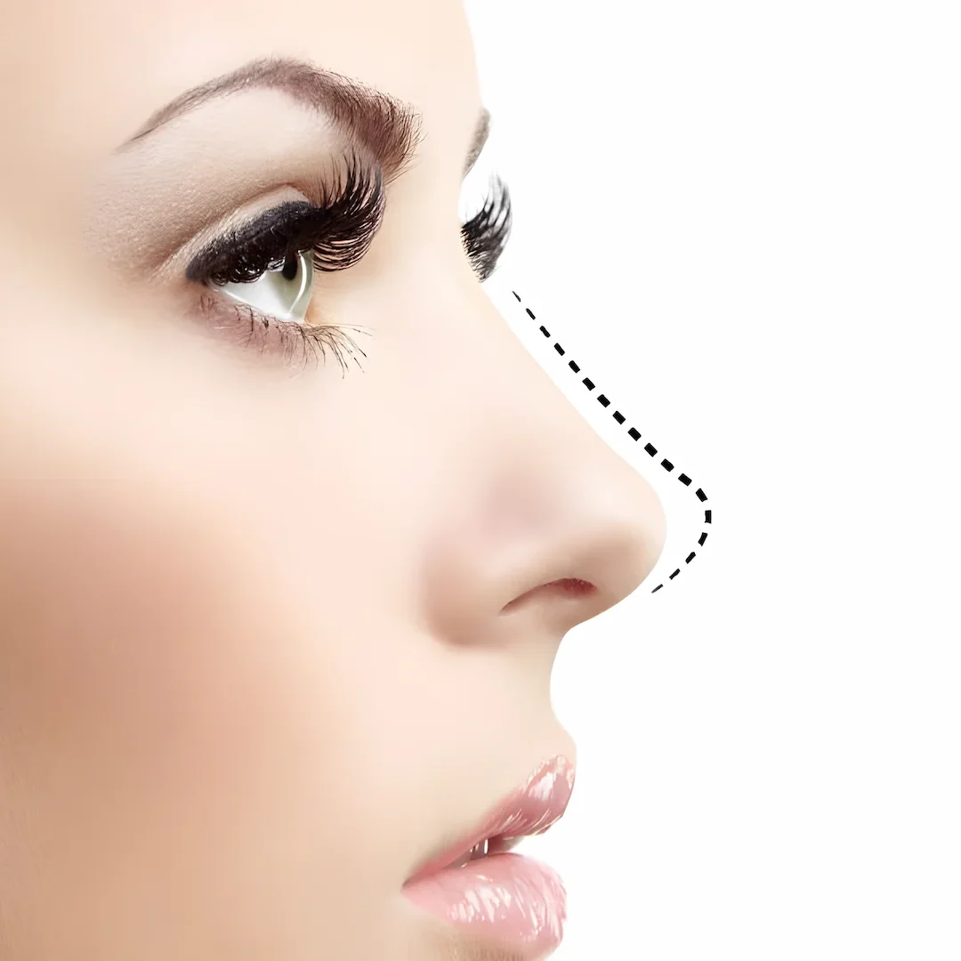 Rhinoplasty nose job