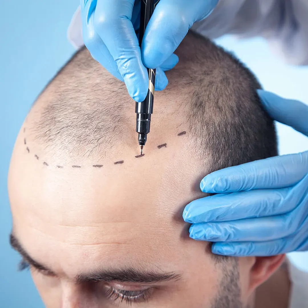 Scalp Hair Transplant